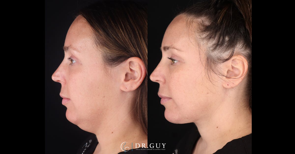 Neck Lift Before & After Gallery - Patient 276936 - Image 2