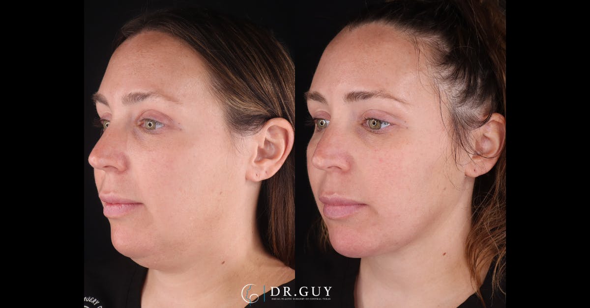 Neck Lift Before & After Gallery - Patient 276936 - Image 1