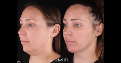 Neck Lift Before & After Gallery - Patient 276936 - Image 1
