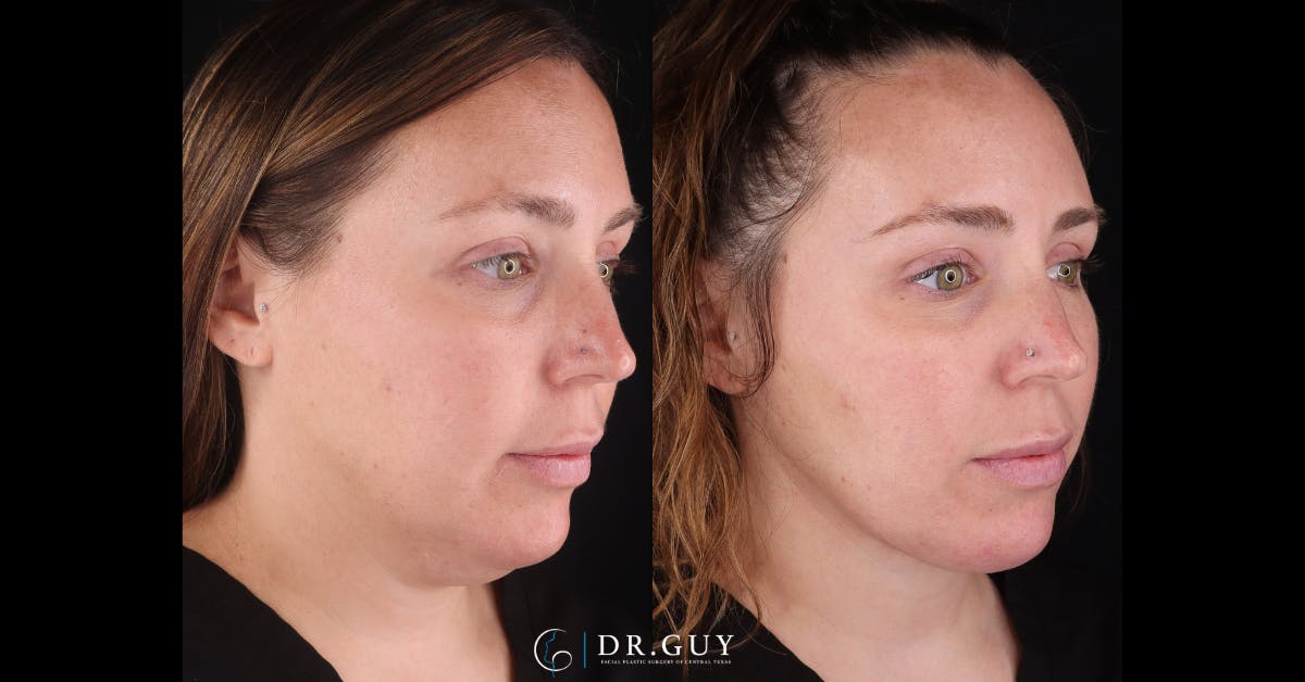 Neck Lift Before & After Gallery - Patient 276936 - Image 5
