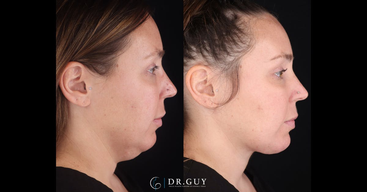 Neck Lift Before & After Gallery - Patient 276936 - Image 4