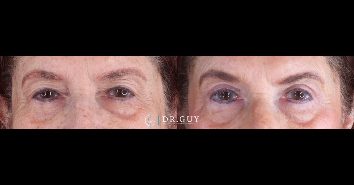 Upper Blepharoplasty Before & After Gallery - Patient 419815 - Image 1