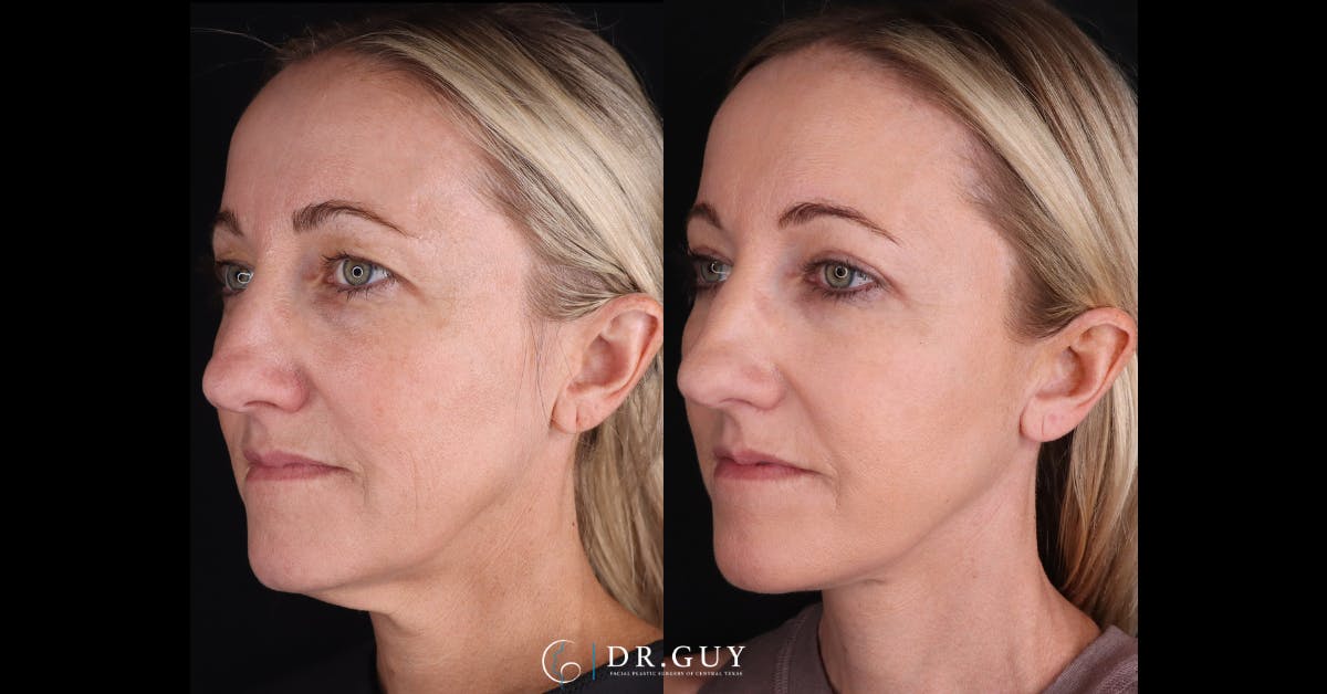Upper Blepharoplasty Before & After Gallery - Patient 191046 - Image 3