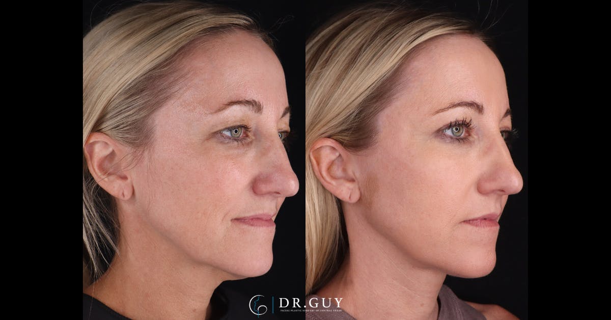 Upper Blepharoplasty Before & After Gallery - Patient 191046 - Image 5