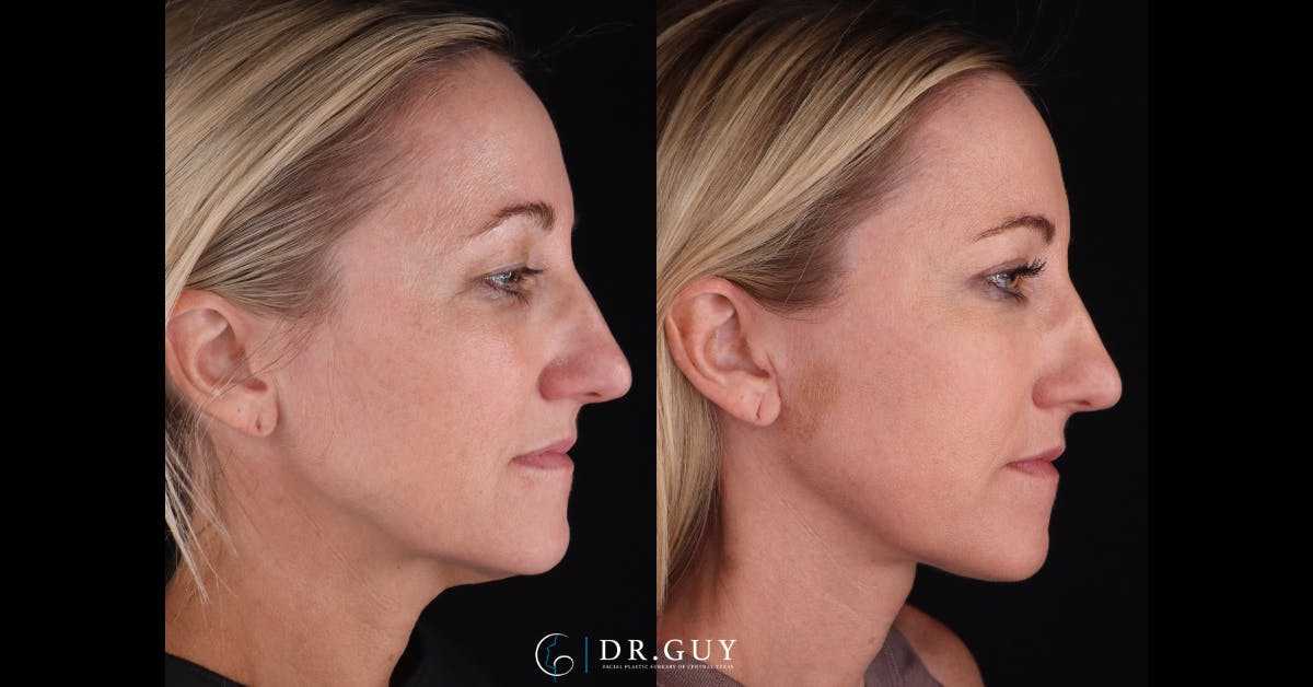Upper Blepharoplasty Before & After Gallery - Patient 191046 - Image 4