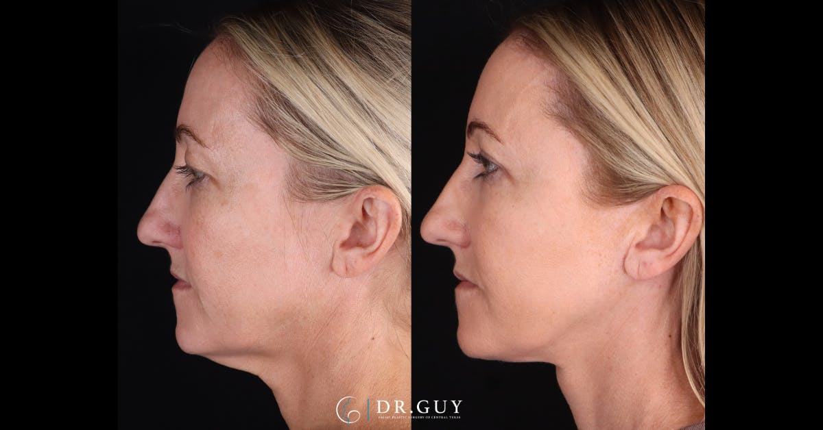 Upper Blepharoplasty Before & After Gallery - Patient 191046 - Image 2