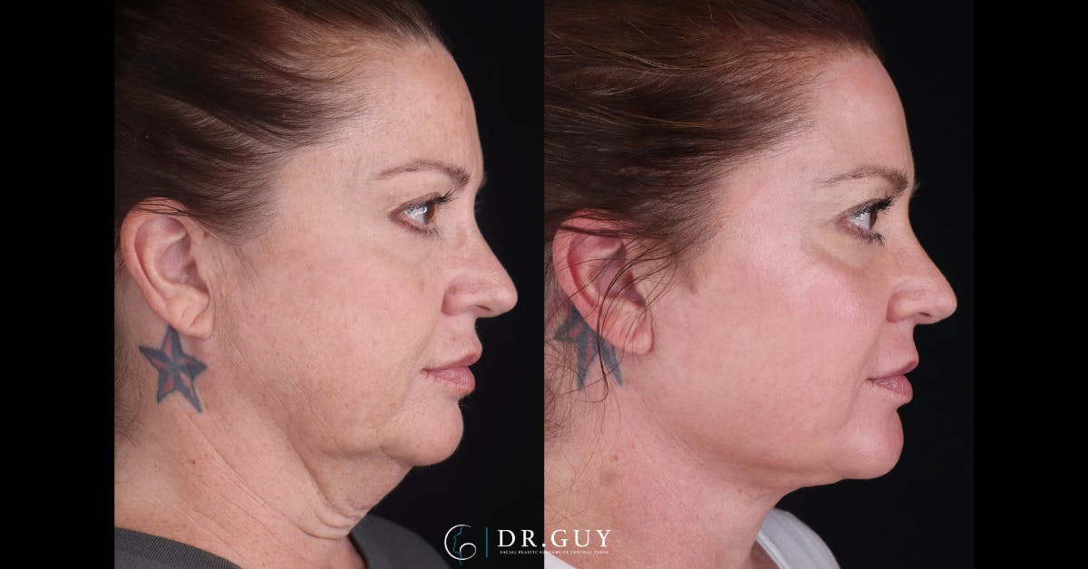 Upper Blepharoplasty Before & After Gallery - Patient 200415 - Image 3