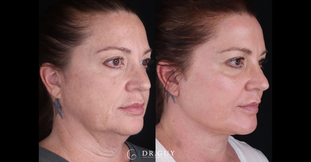 Upper Blepharoplasty Before & After Gallery - Patient 200415 - Image 4