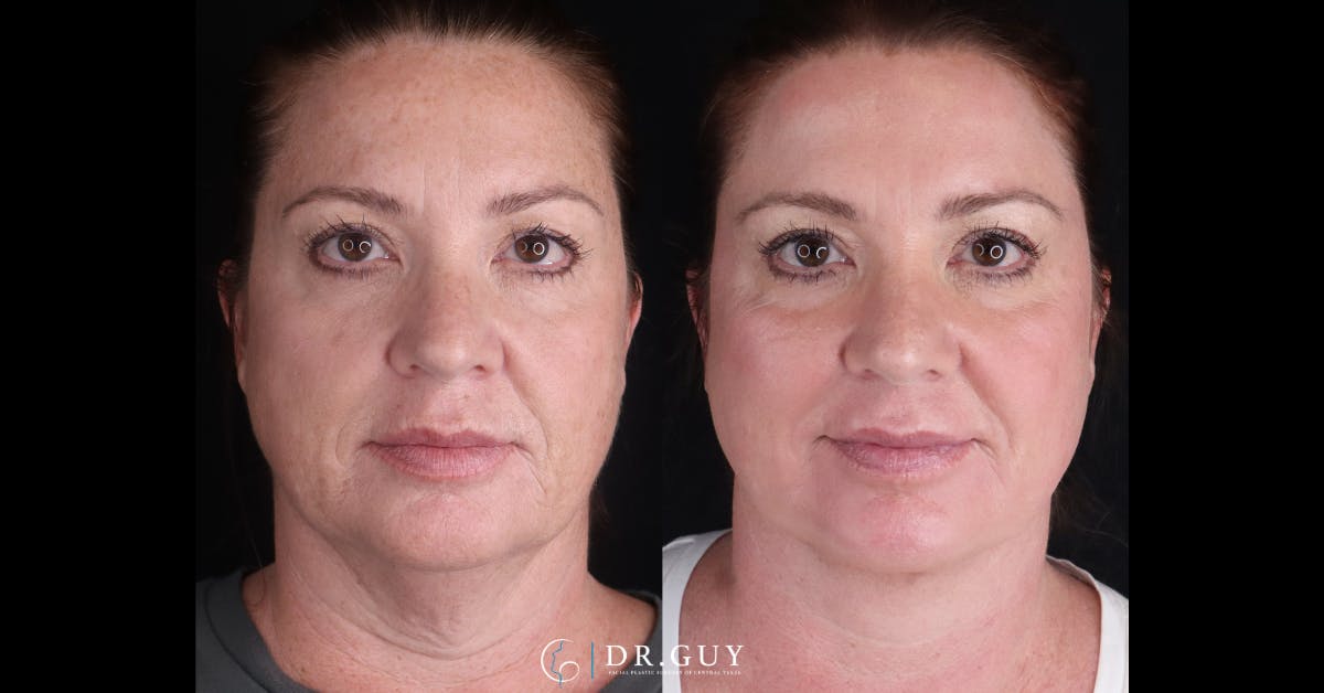 Upper Blepharoplasty Before & After Gallery - Patient 200415 - Image 1