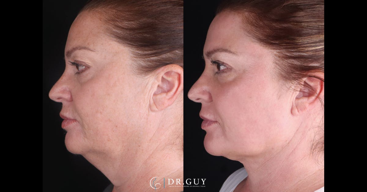 Upper Blepharoplasty Before & After Gallery - Patient 200415 - Image 2
