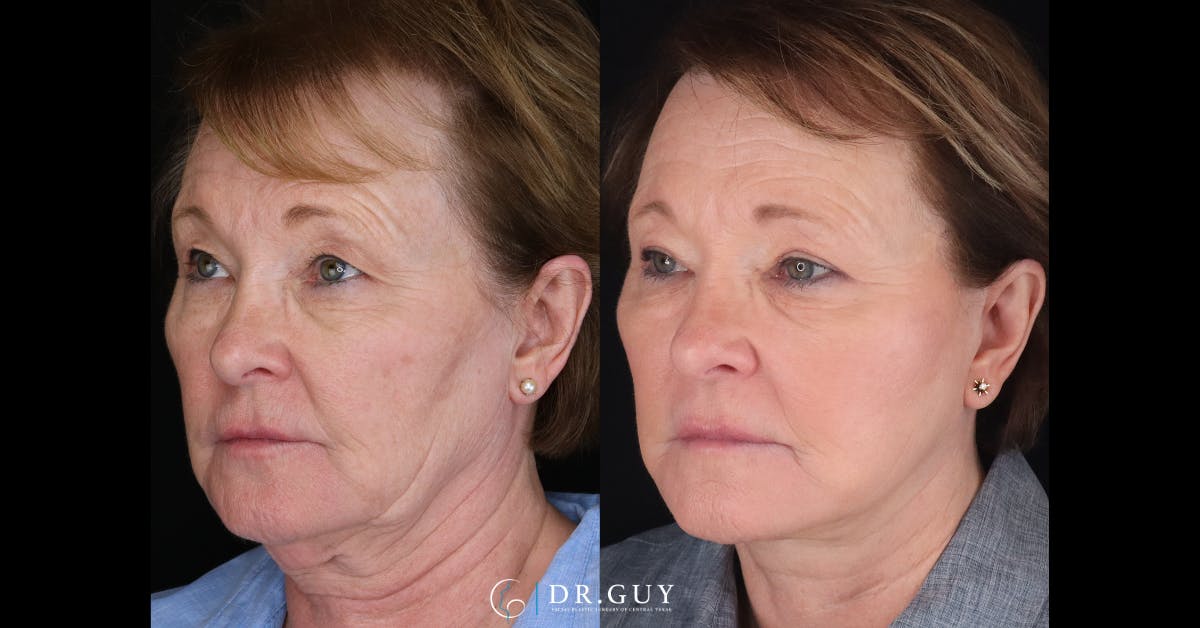 Facelift Before & After Gallery - Patient 408116 - Image 3