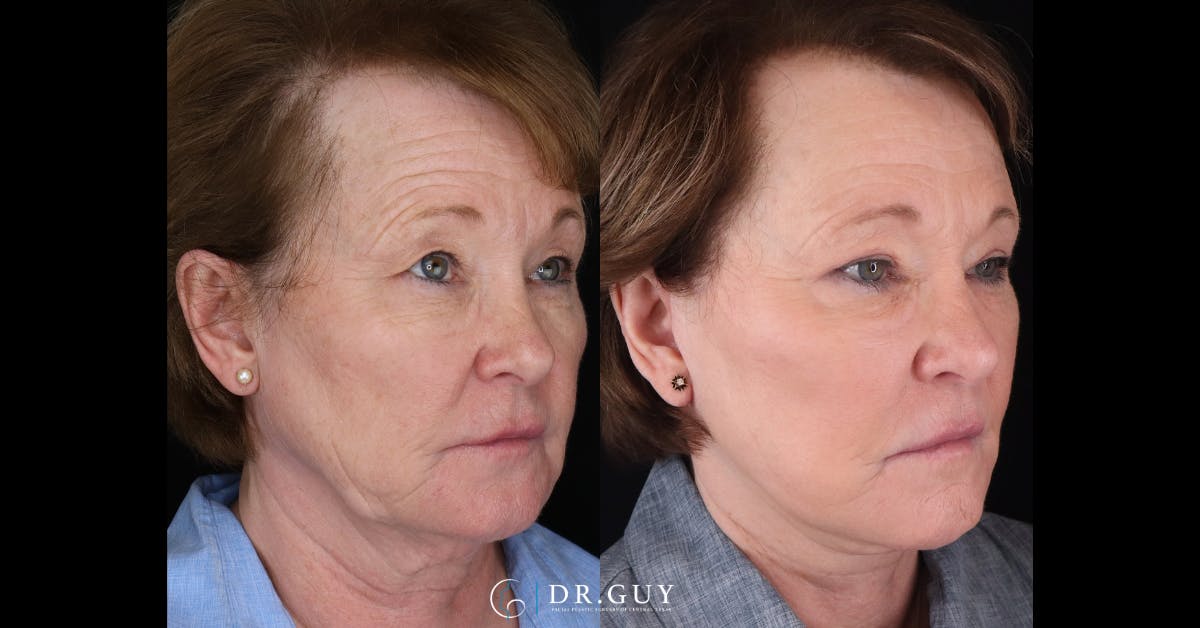 Facelift Before & After Gallery - Patient 408116 - Image 2