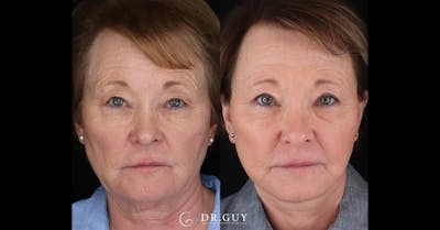 Facelift Before & After Gallery - Patient 408116 - Image 1