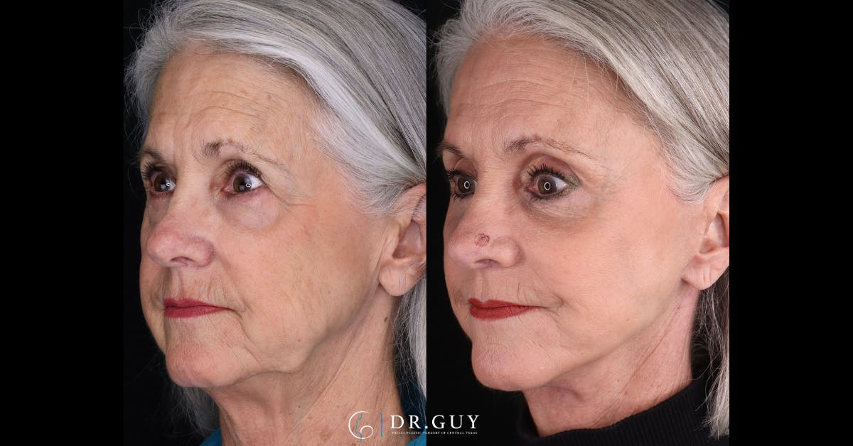 Facelift Before & After Gallery - Patient 279990 - Image 4