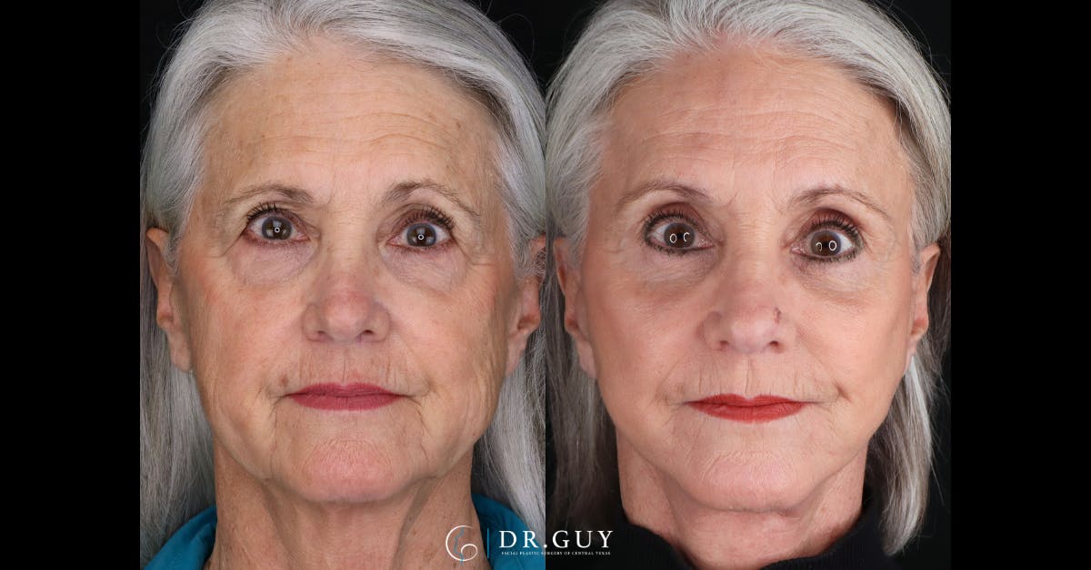 Facelift Before & After Gallery - Patient 279990 - Image 1