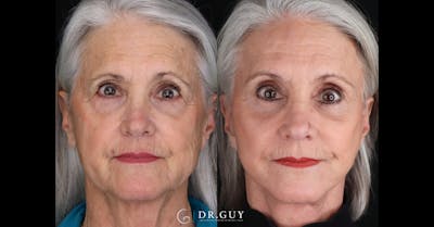 Facelift Before & After Gallery - Patient 279990 - Image 1