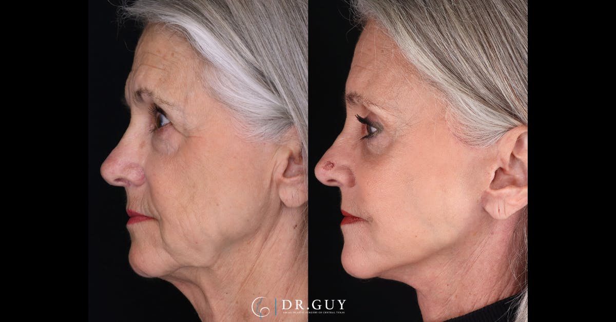 Facelift Before & After Gallery - Patient 279990 - Image 5