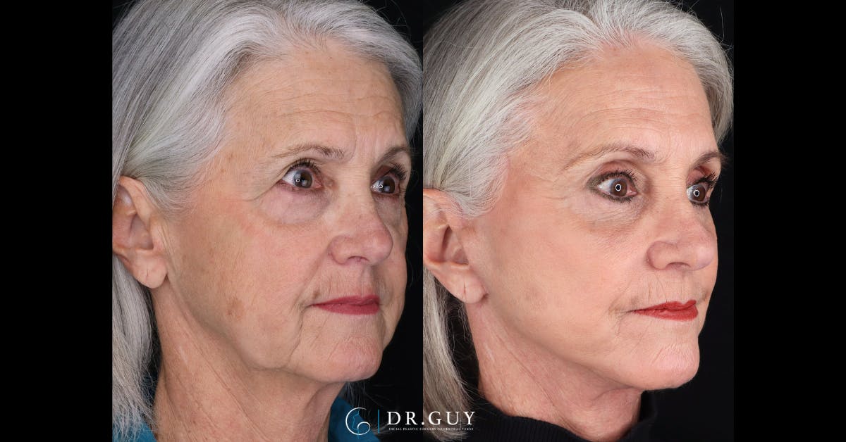 Facelift Before & After Gallery - Patient 279990 - Image 2