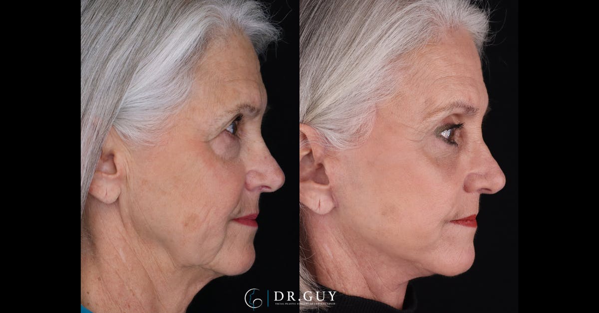 Facelift Before & After Gallery - Patient 279990 - Image 3