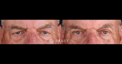 Browlift Before & After Gallery - Patient 317256 - Image 1