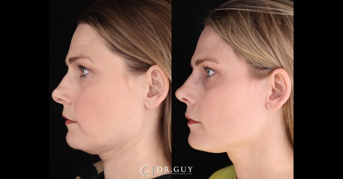 Neck Lift Before & After Gallery - Patient 272802 - Image 1
