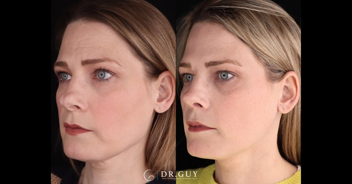 Neck Lift Before & After Gallery - Patient 272802 - Image 2