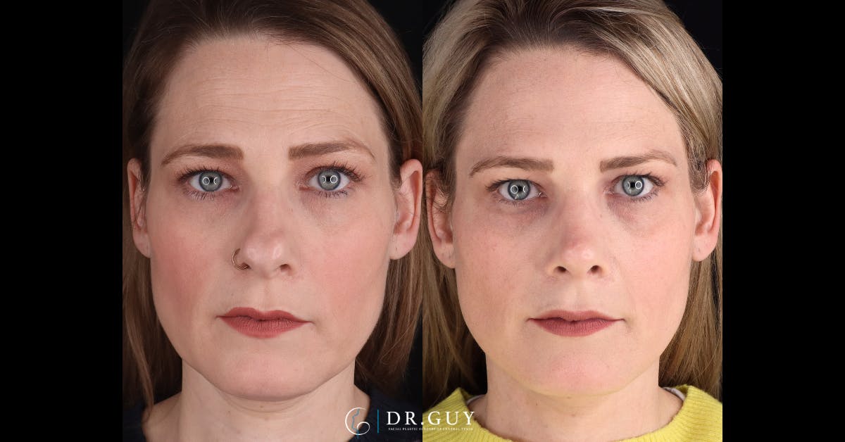 Neck Lift Before & After Gallery - Patient 272802 - Image 3