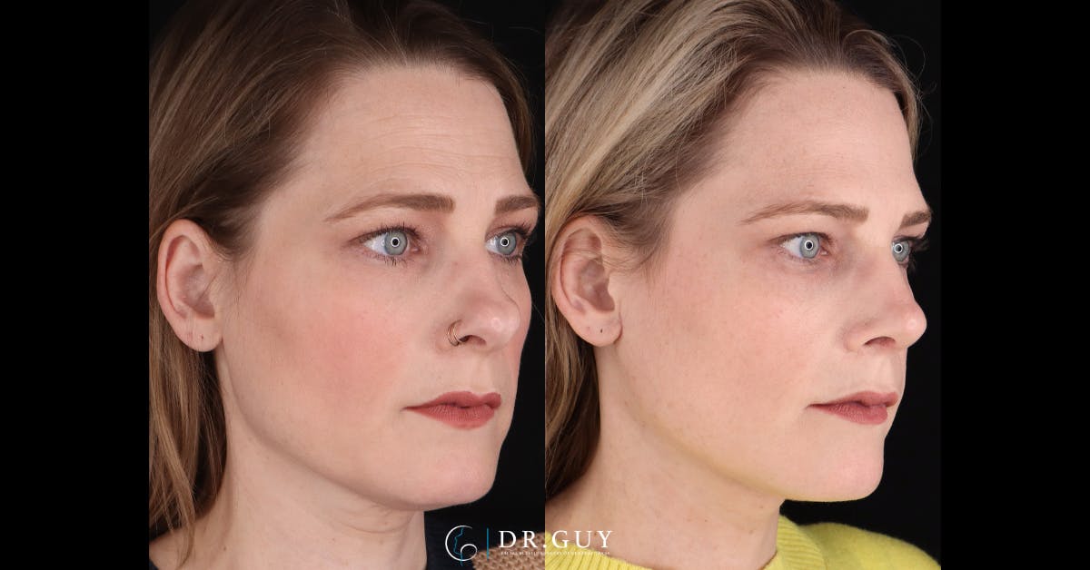 Neck Lift Before & After Gallery - Patient 272802 - Image 4