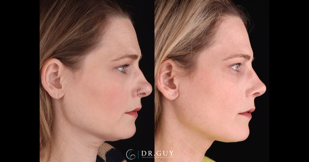 Neck Lift Before & After Gallery - Patient 272802 - Image 5