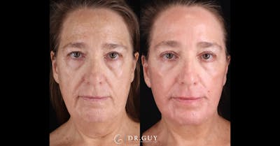 Facelift Before & After Gallery - Patient 139553 - Image 1