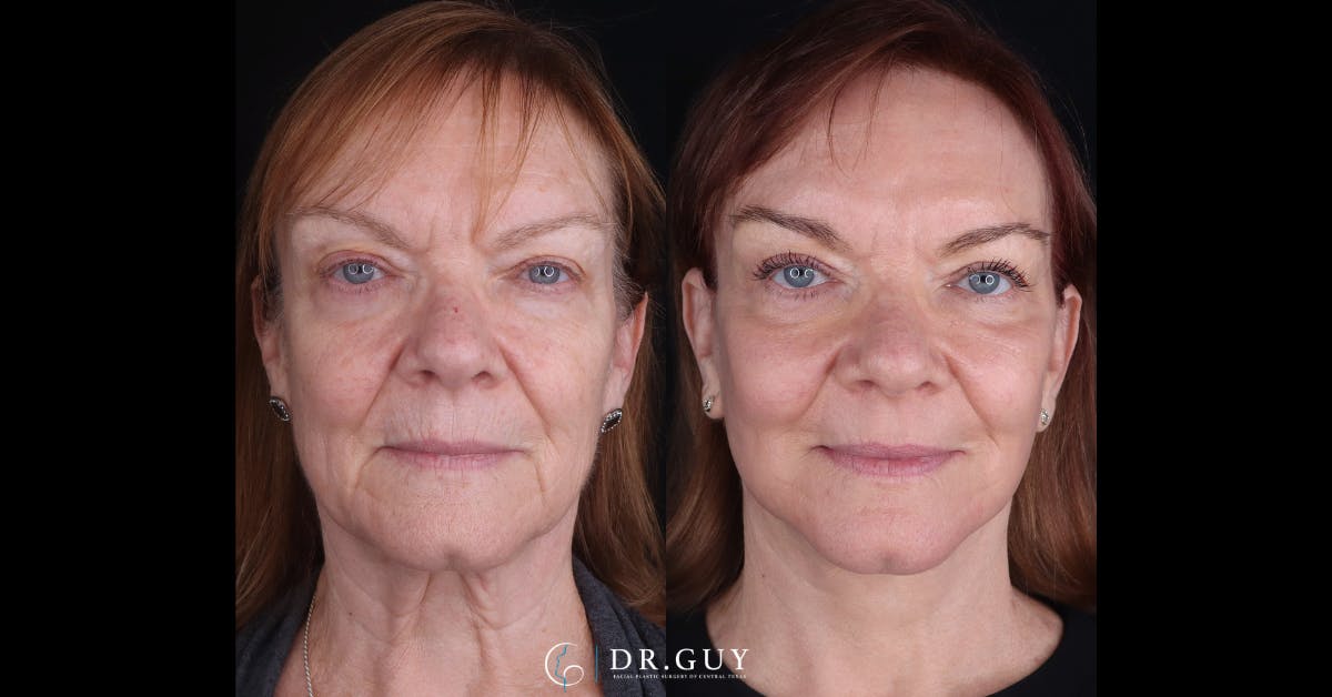 Facelift Before & After Gallery - Patient 239164 - Image 1