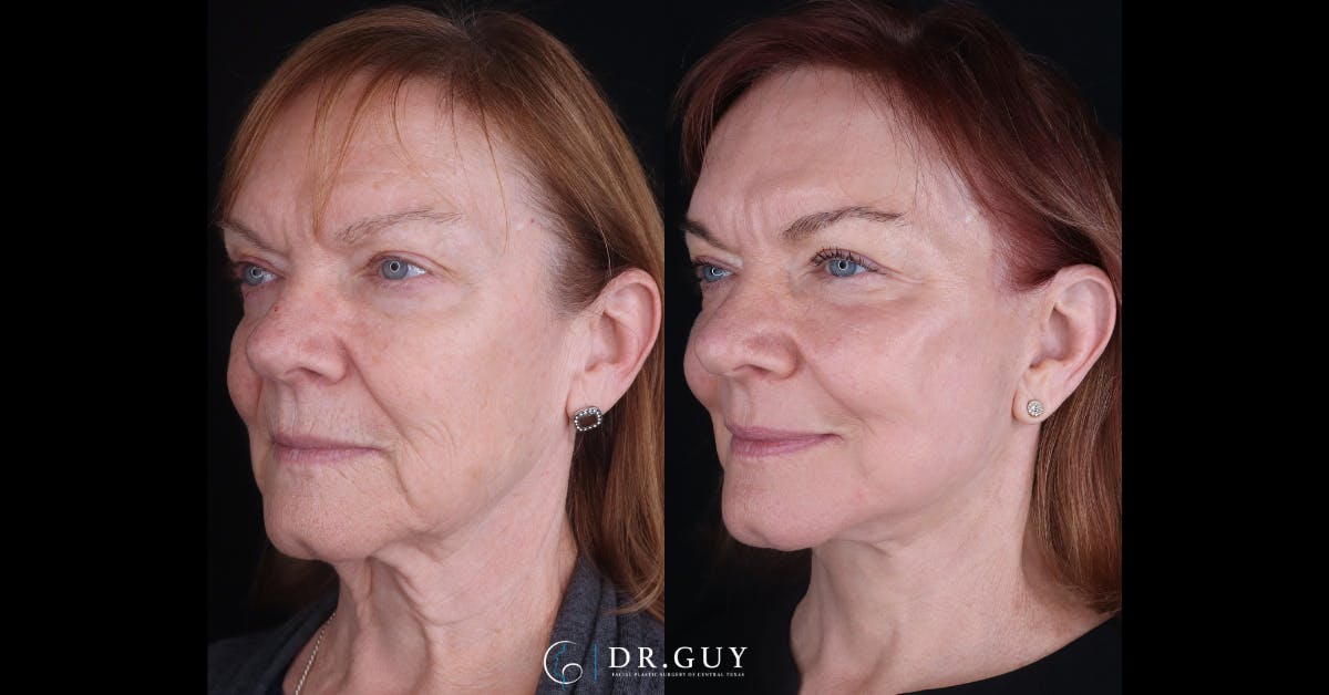 Facelift Before & After Gallery - Patient 239164 - Image 3
