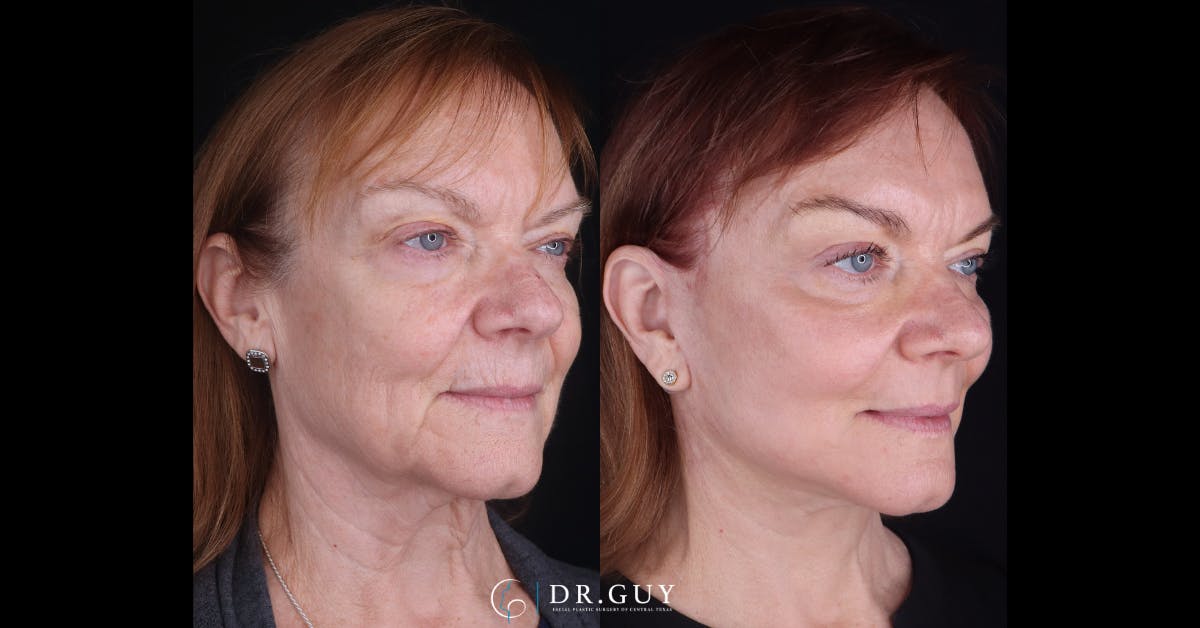 Facelift Before & After Gallery - Patient 239164 - Image 2
