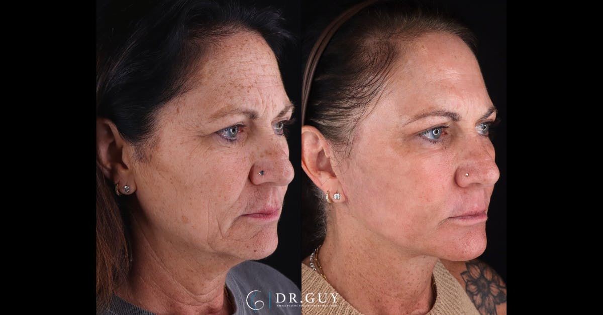 Laser Before & After Gallery - Patient 418616 - Image 2