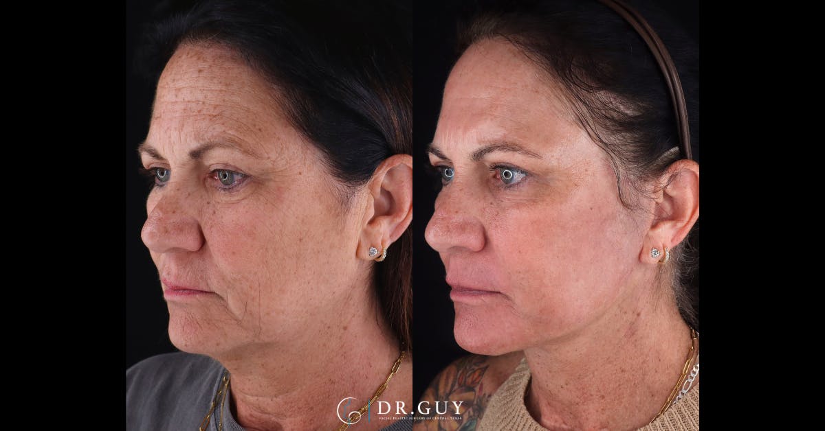 Laser Before & After Gallery - Patient 418616 - Image 4