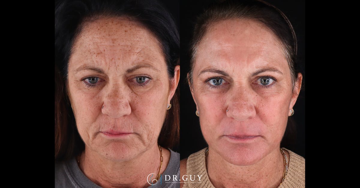 Laser Before & After Gallery - Patient 418616 - Image 1