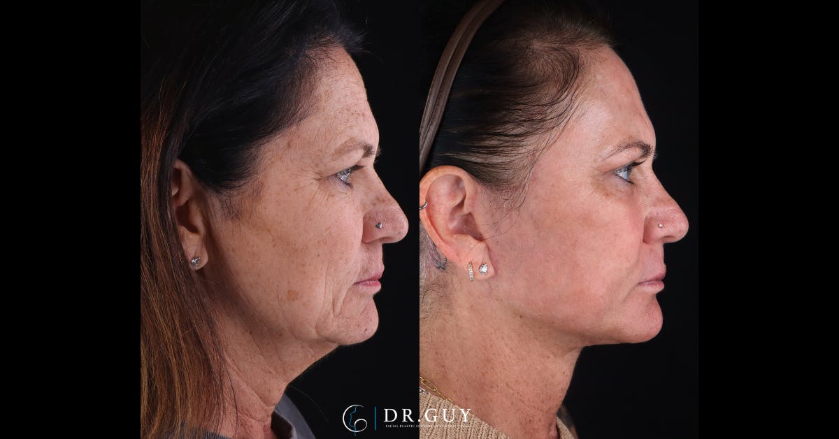 Laser Before & After Gallery - Patient 418616 - Image 3