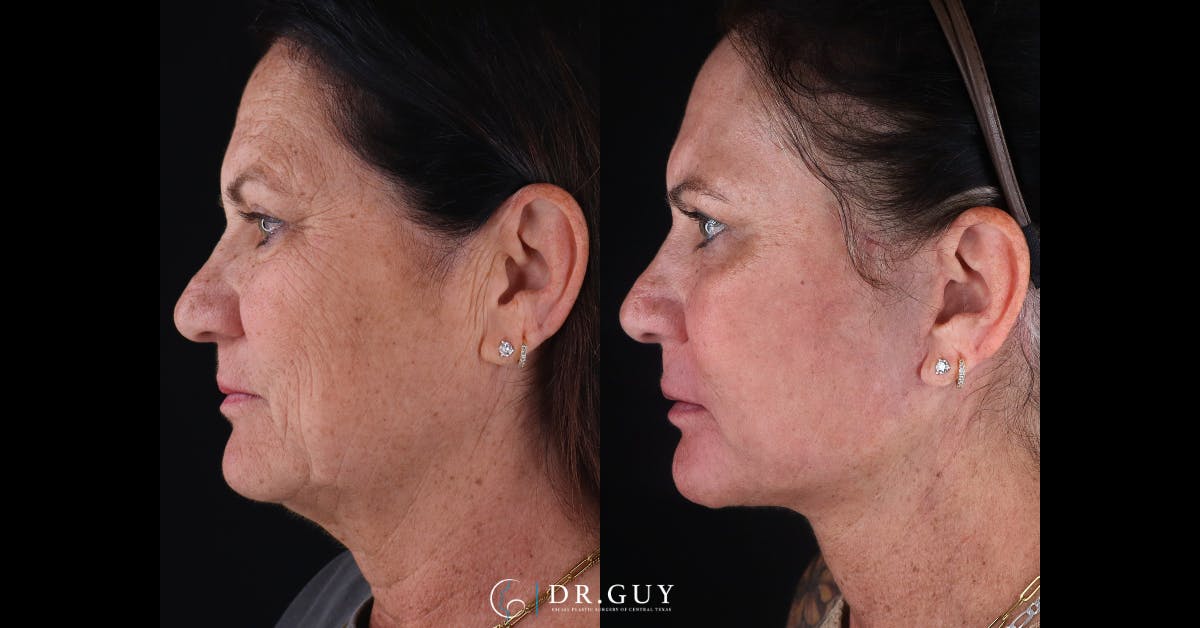 Laser Before & After Gallery - Patient 418616 - Image 5