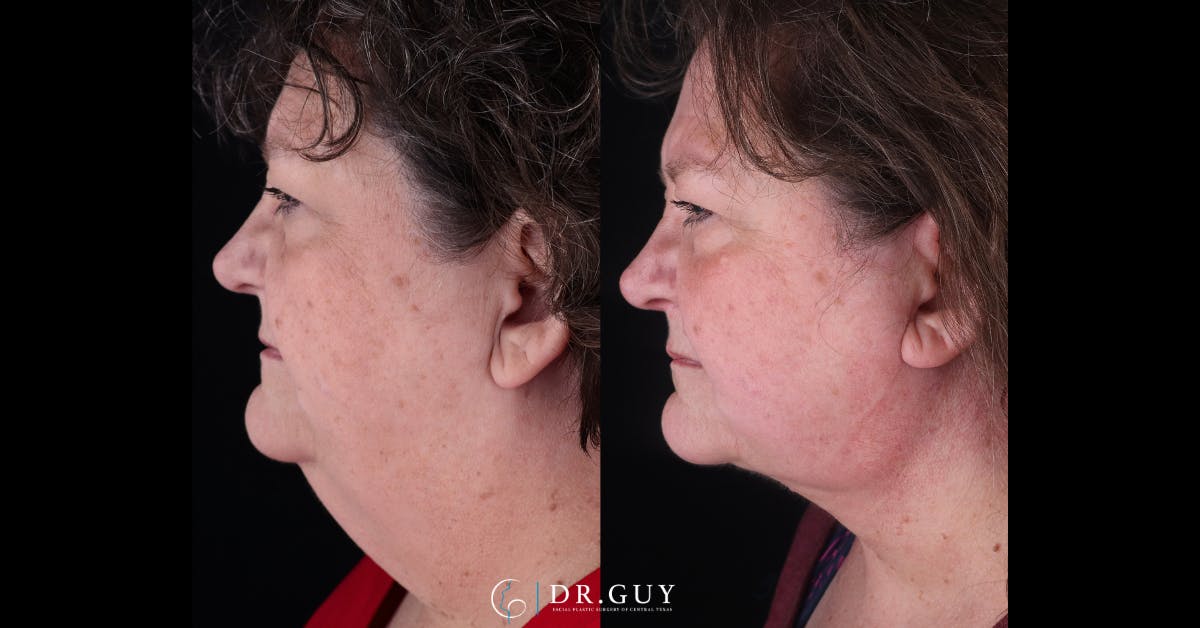 Neck Lift Before & After Gallery - Patient 743902 - Image 4