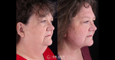 Neck Lift Before & After Gallery - Patient 743902 - Image 1