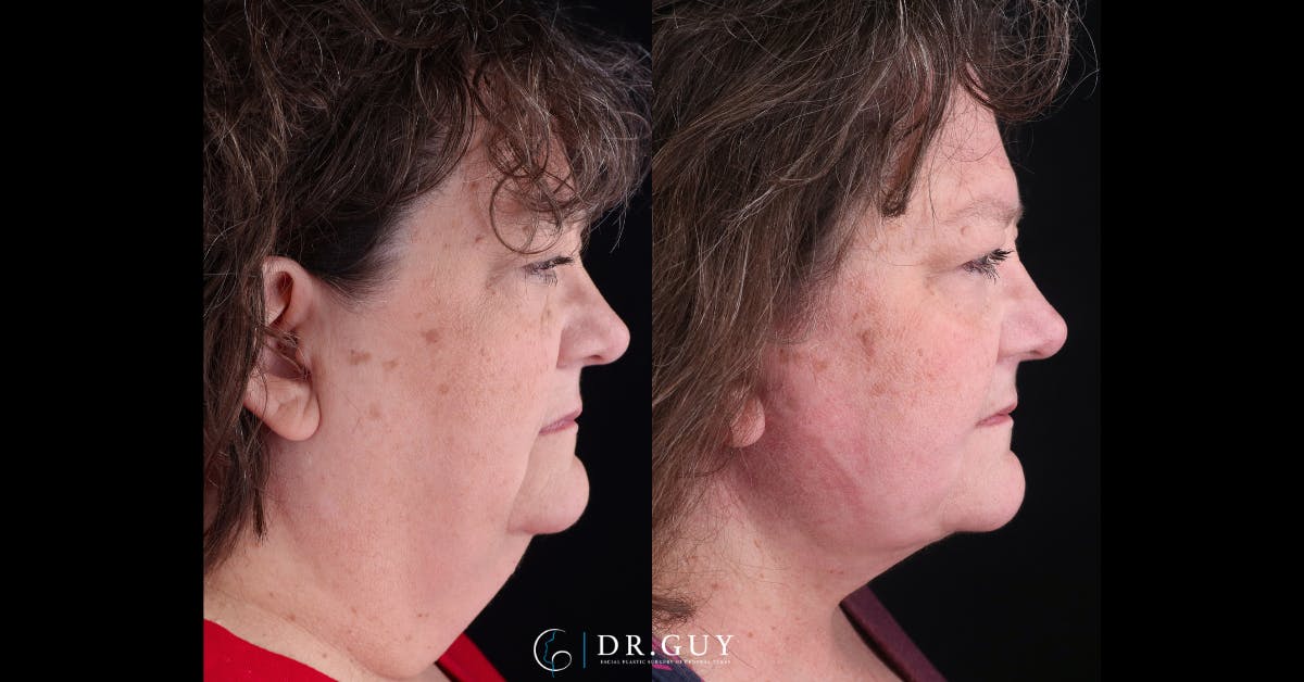 Neck Lift Before & After Gallery - Patient 743902 - Image 3
