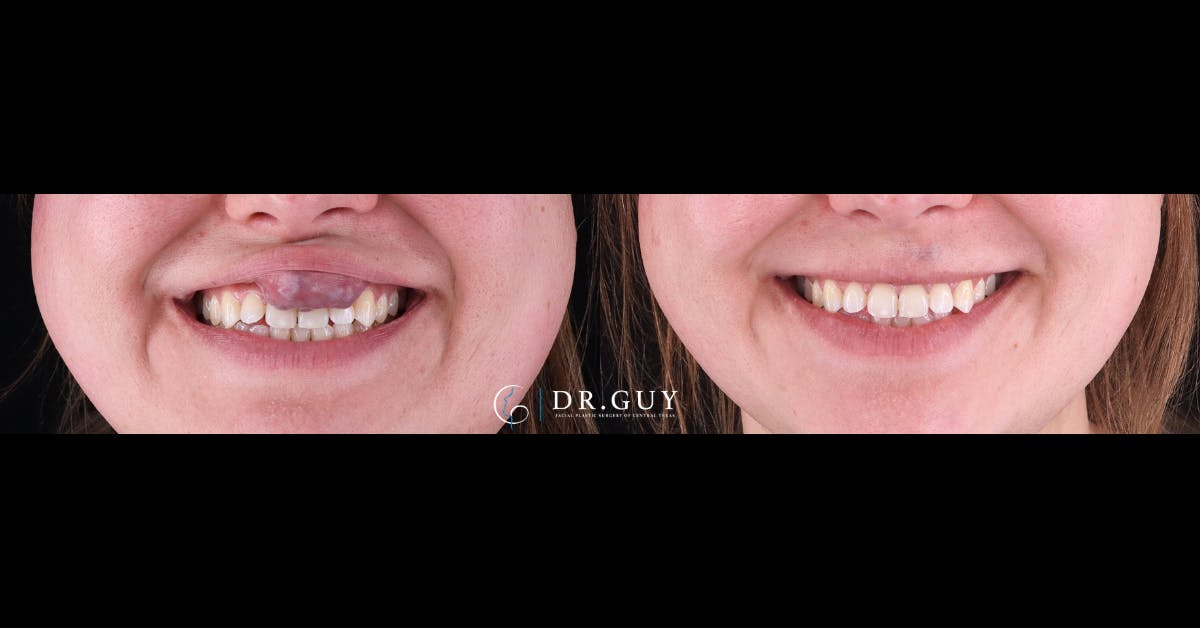 Scar Revision Before & After Gallery - Patient 292017 - Image 1