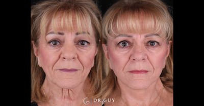 Facelift Before & After Gallery - Patient 521318 - Image 1