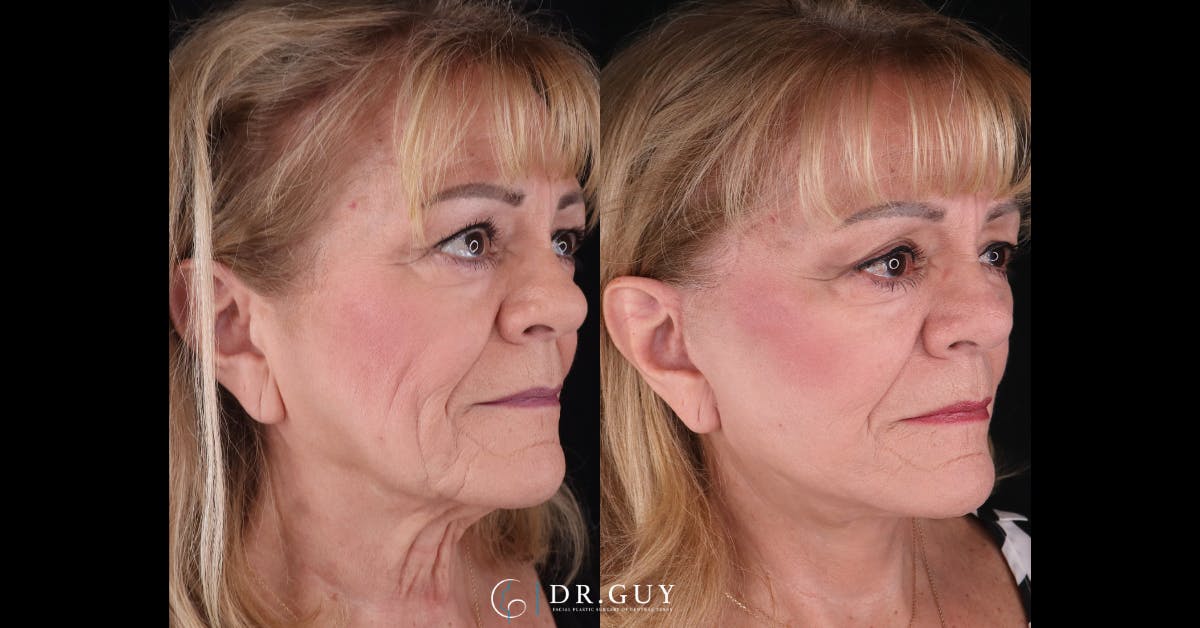 Facelift Before & After Gallery - Patient 521318 - Image 2