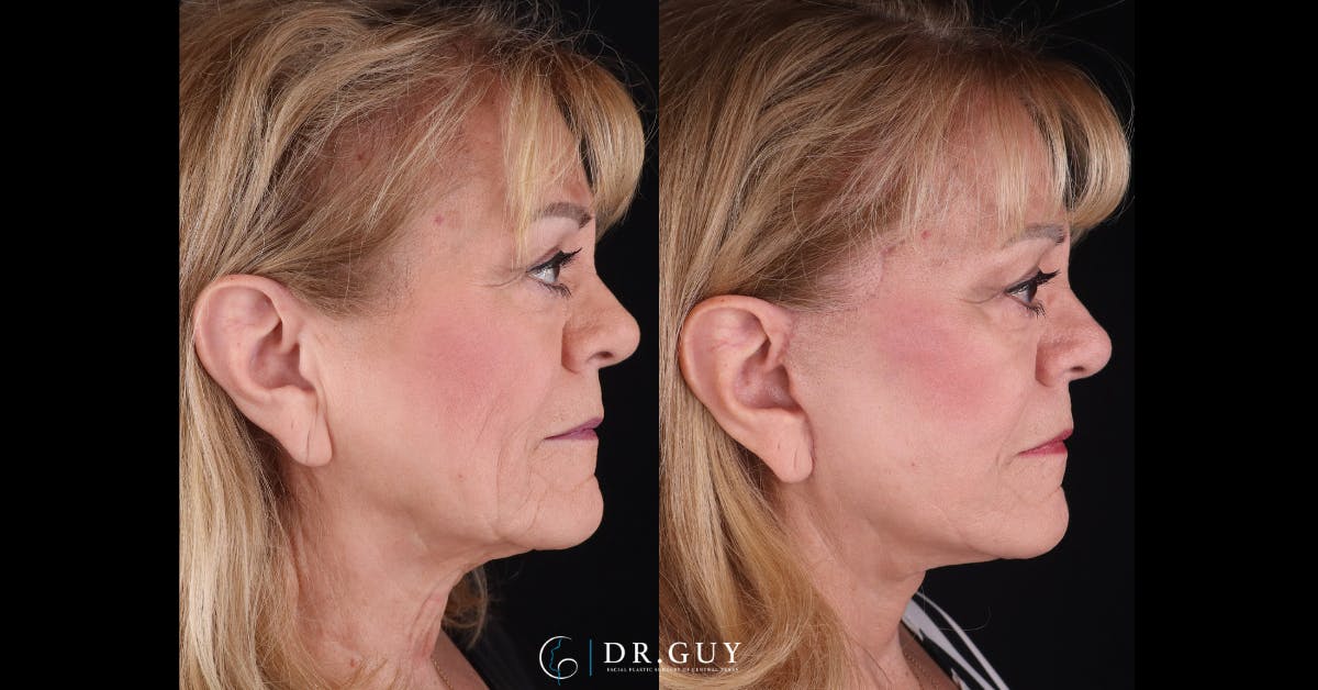 Facelift Before & After Gallery - Patient 521318 - Image 3