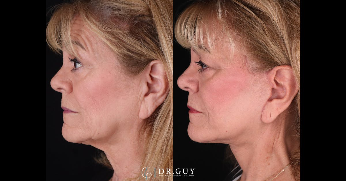 Facelift Before & After Gallery - Patient 521318 - Image 5
