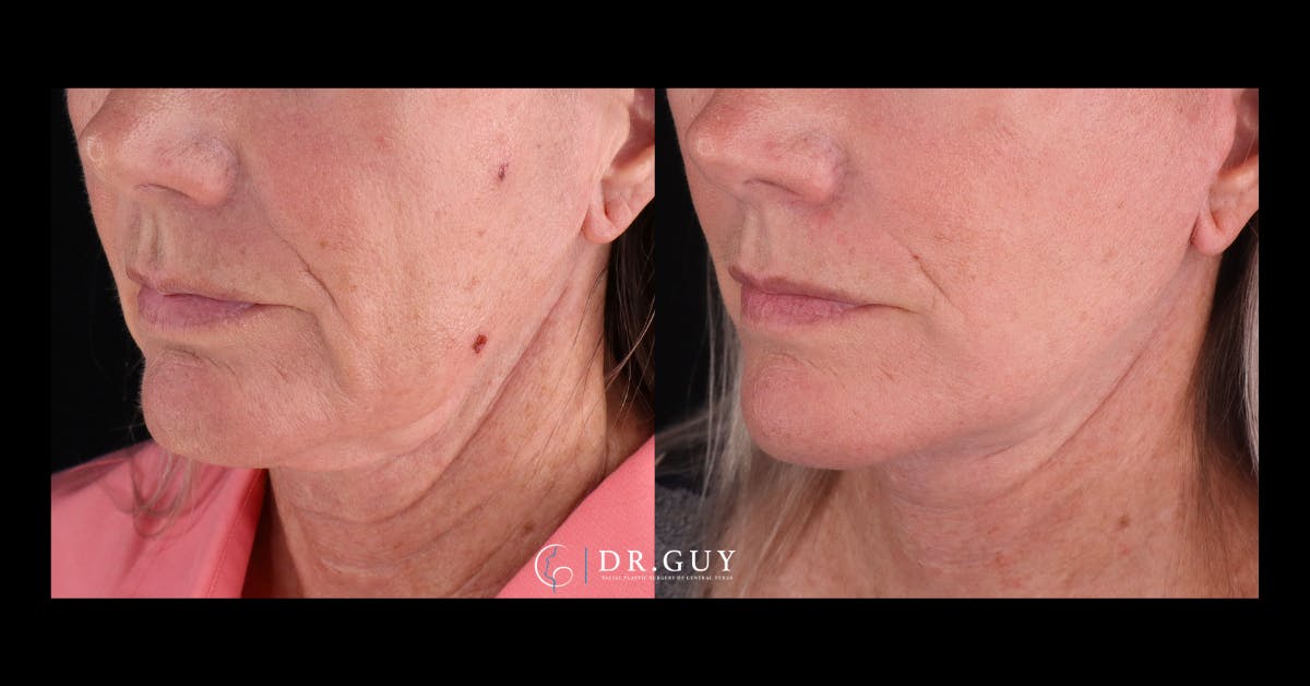 Facelift Before & After Gallery - Patient 251863 - Image 3