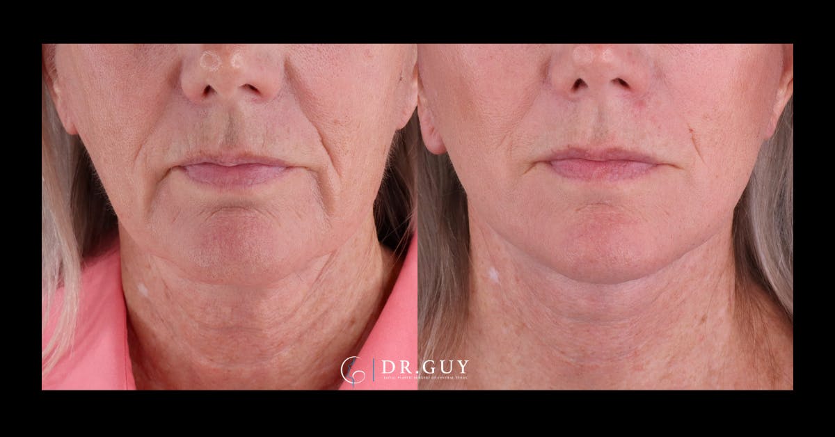 Facelift Before & After Gallery - Patient 251863 - Image 1