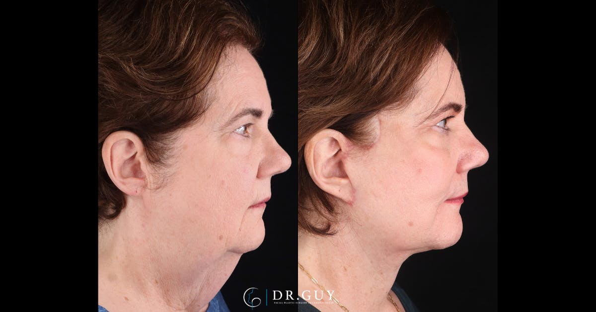 Facelift Before & After Gallery - Patient 205977 - Image 3