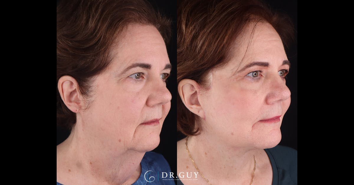 Facelift Before & After Gallery - Patient 205977 - Image 2